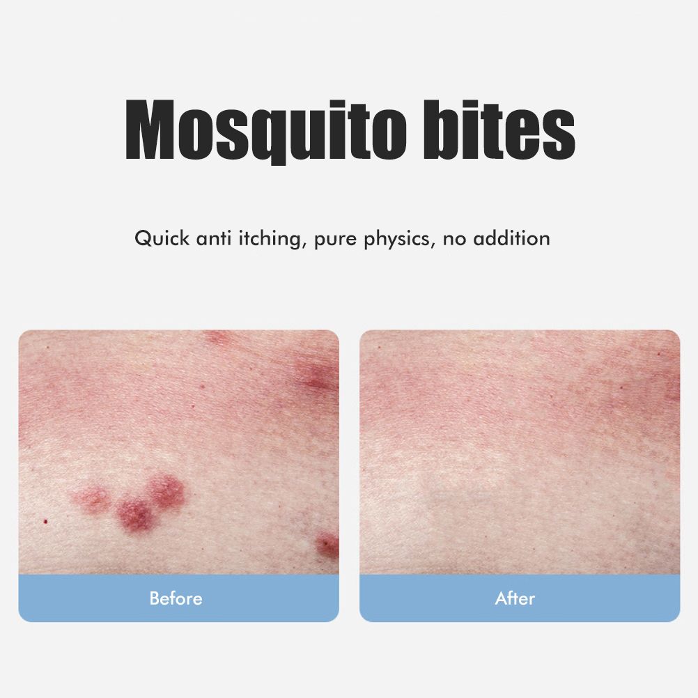 Bug Bite Itch Relief Tool USB Rechargeable Mosquito Bite Sucker Chemical Free for Bug Bites Bee Wasp Stings - view 4